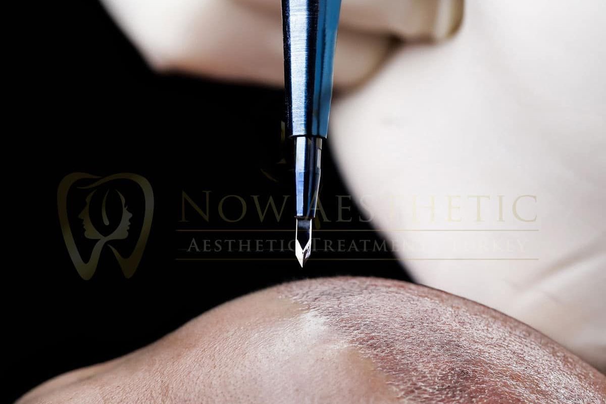 SAÇ EKİMİ  (SAFİR TEKNİĞİ İLE )