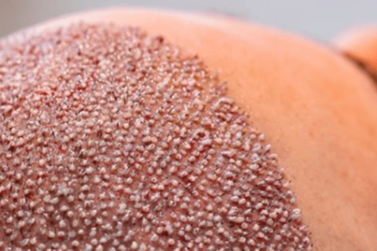 SAÇ EKİMİ FUE TEKNİĞİ İLE 