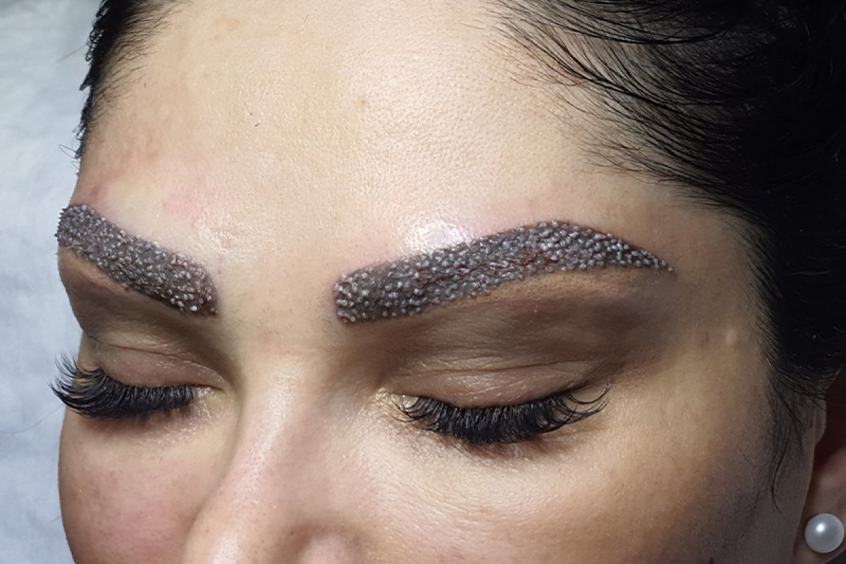 KAŞ EKİMİ ( FUE TEKNİĞİ İLE )