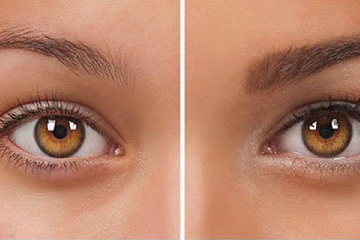 KAŞ EKİMİ ( FUE TEKNİĞİ İLE )