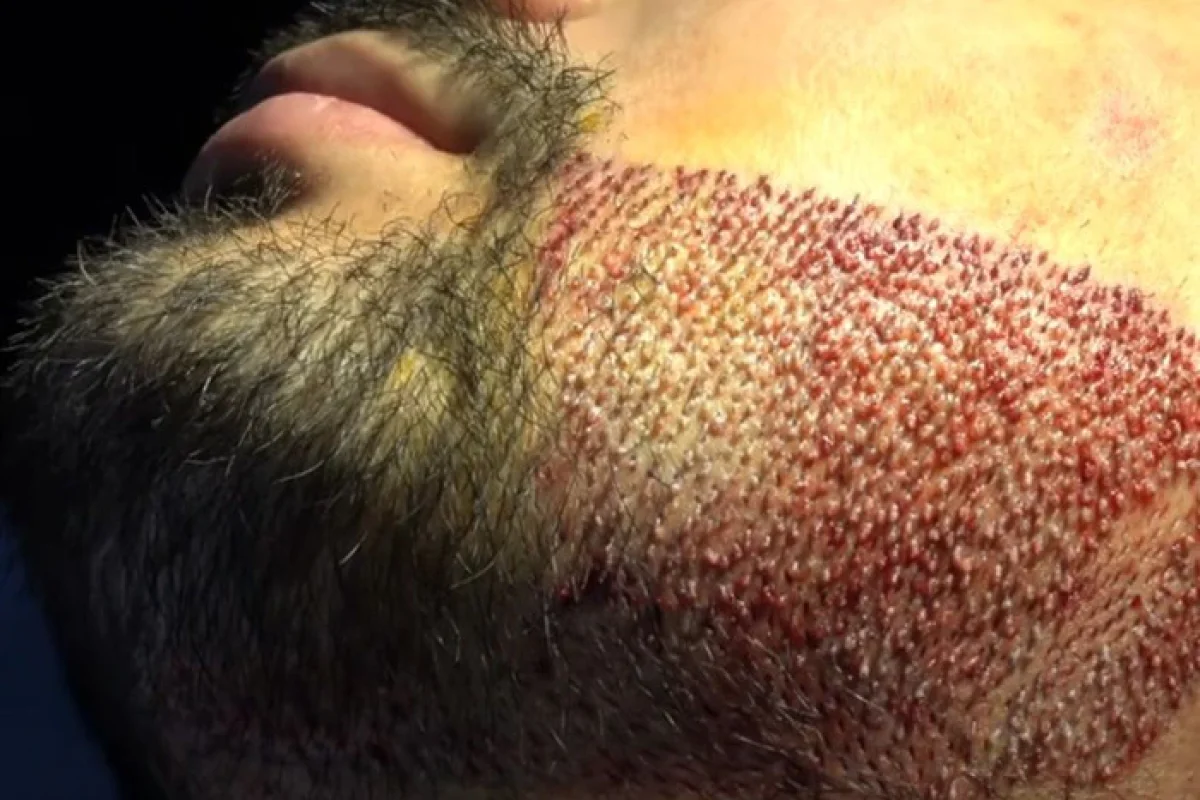 SAKAL EKİMİ FUE TEKNİĞİ İLE 